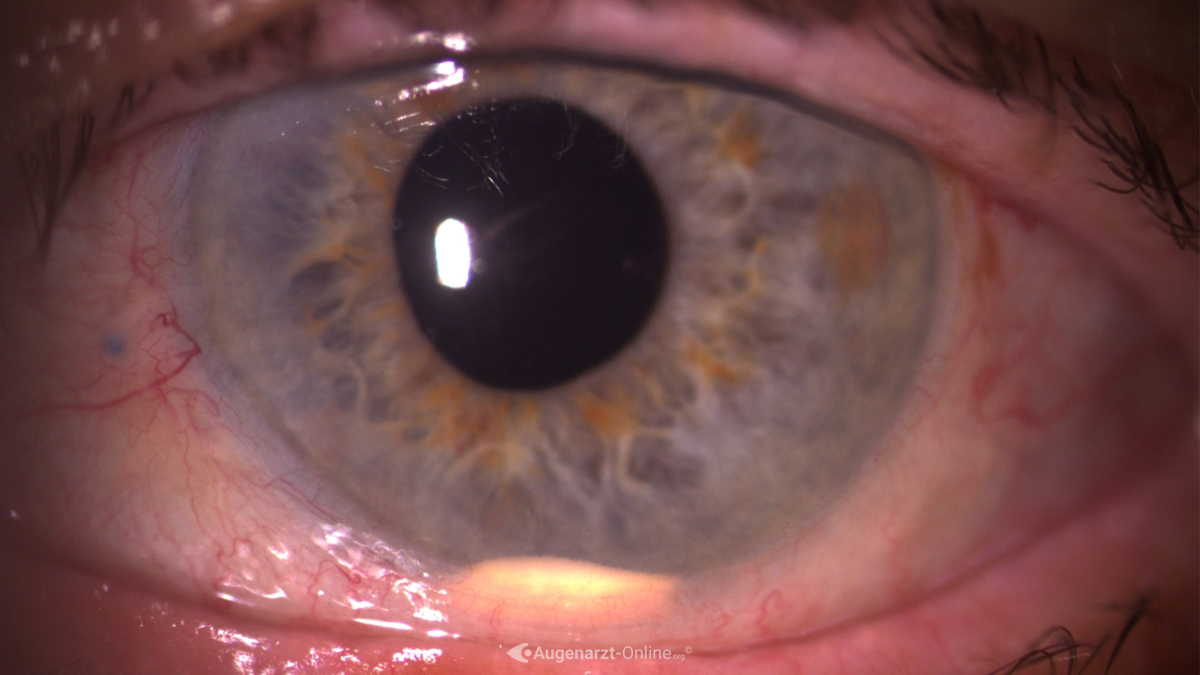 Endophthalmitis