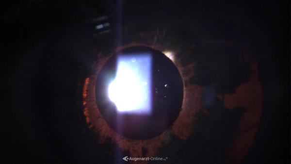 Iristransilluminationsdefekt Irisrandsaumatrophie