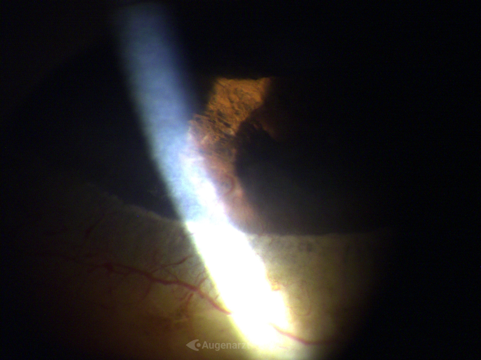 Medizinische Dokumentation: ICE Syndrom (Iridokorneales endotheliales Syndrom) (Spaltlampenfoto).