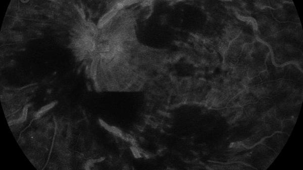 Zentralvenenthrombose