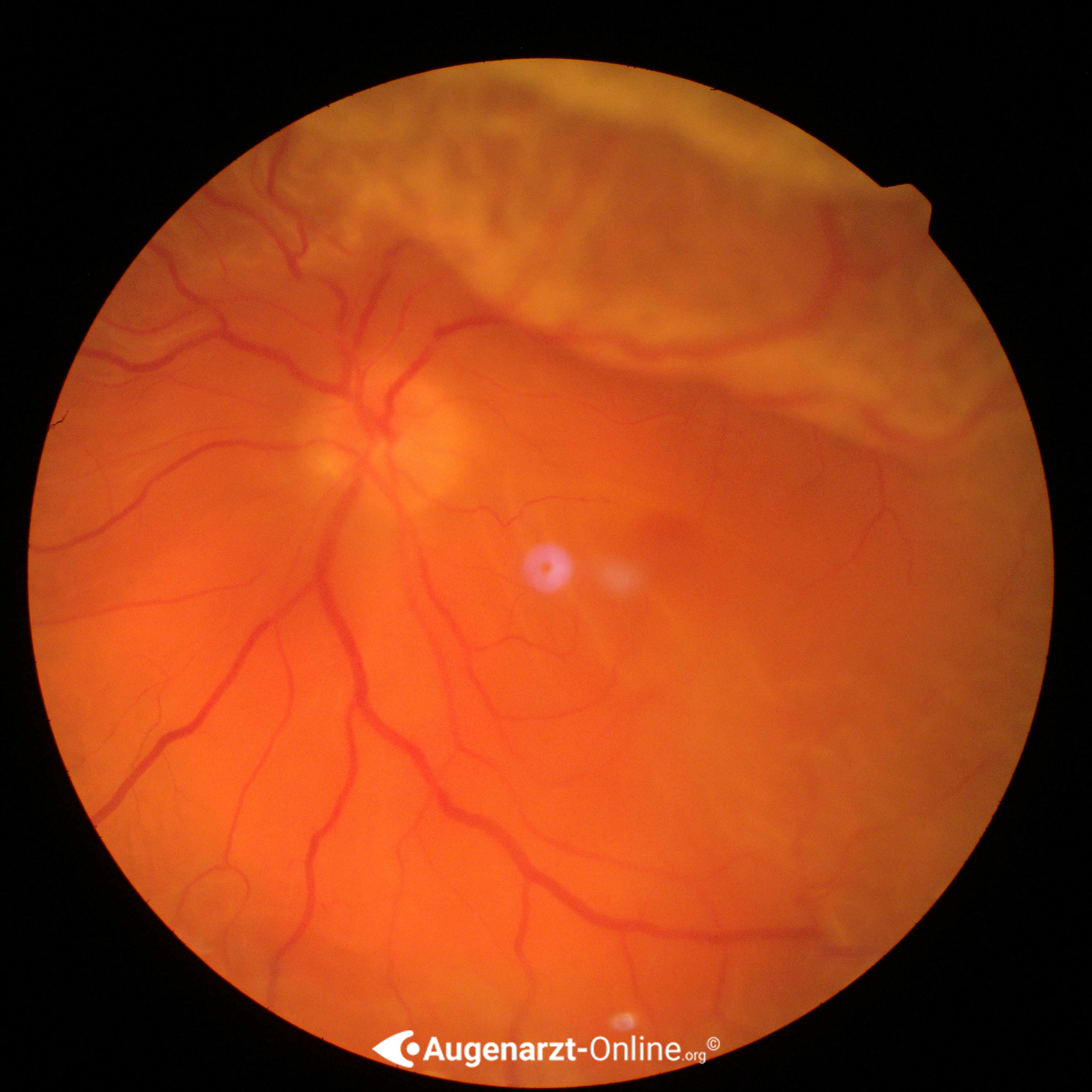Netzhautablösung (Makula Off Ablatio retinae))