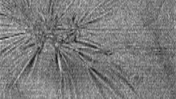 Epiretinale Membran