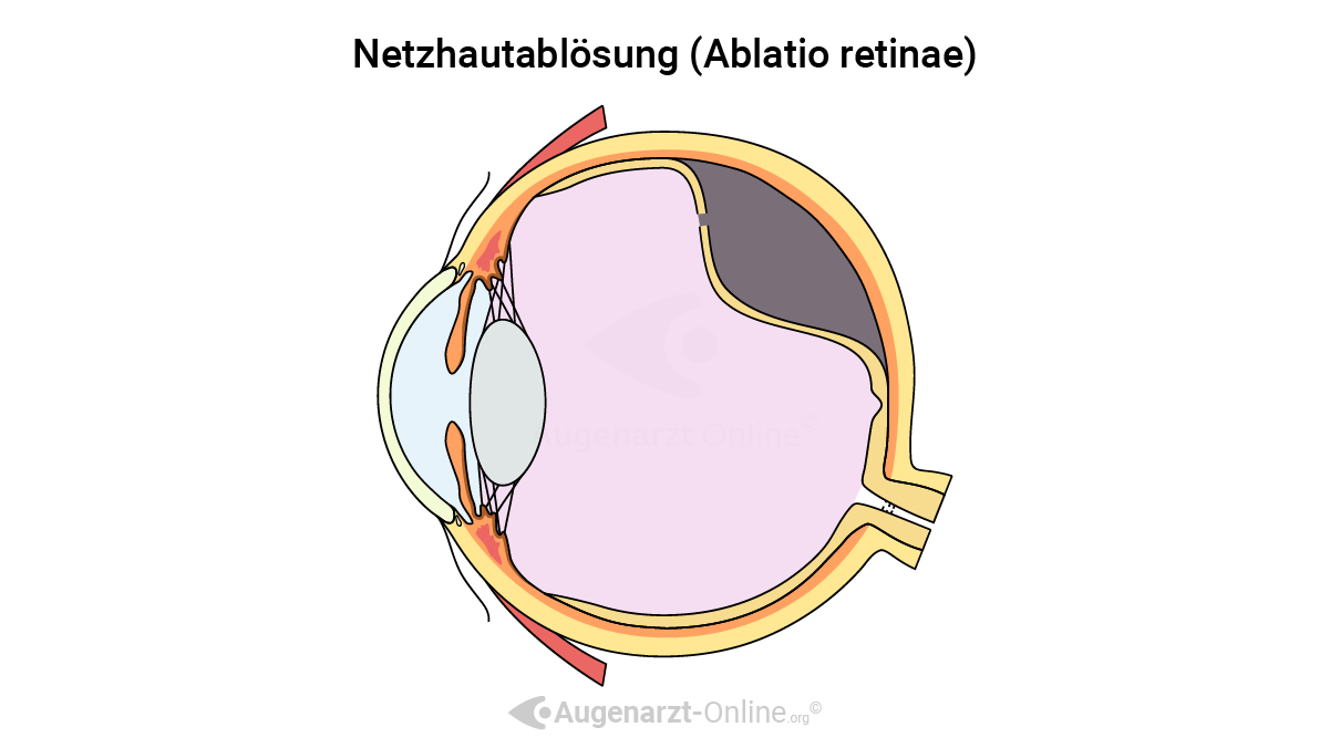 Illustration einer rissbedingten Netzhautablösung (rhegmatogene Ablatio)