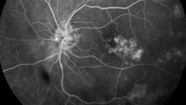 Choroiditis