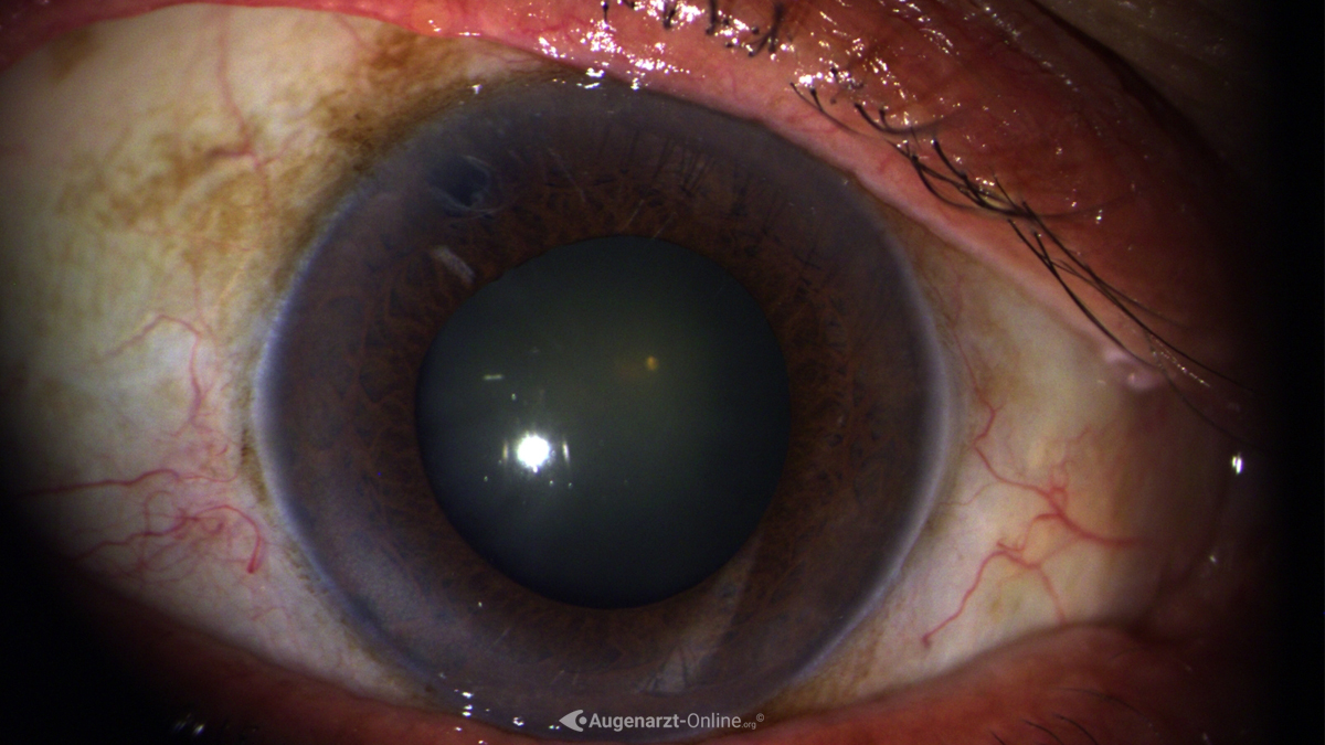 Iridotomie