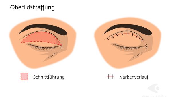 Oberlidstraffung und Augenbrauenlifting natürliche Verjüngung des Blicks