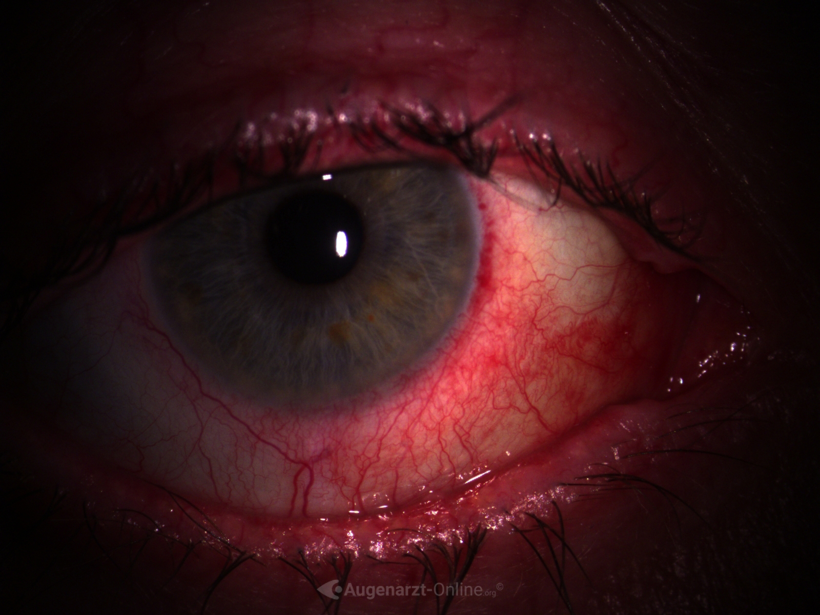 Medizinische Dokumentation: Episkleritis (Spaltlampenfoto).