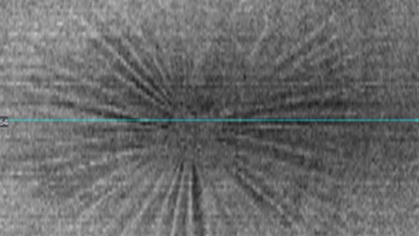 Sternfalten bei Epiretinaler Gliose