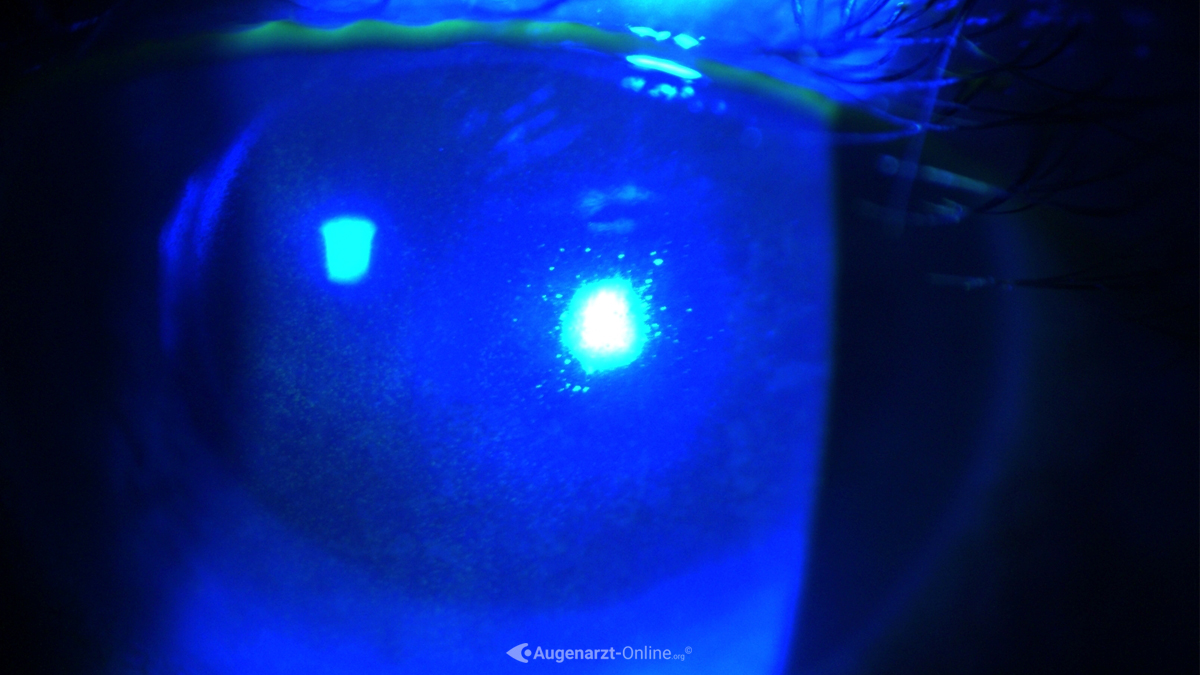 Punctate fluorescein staining
