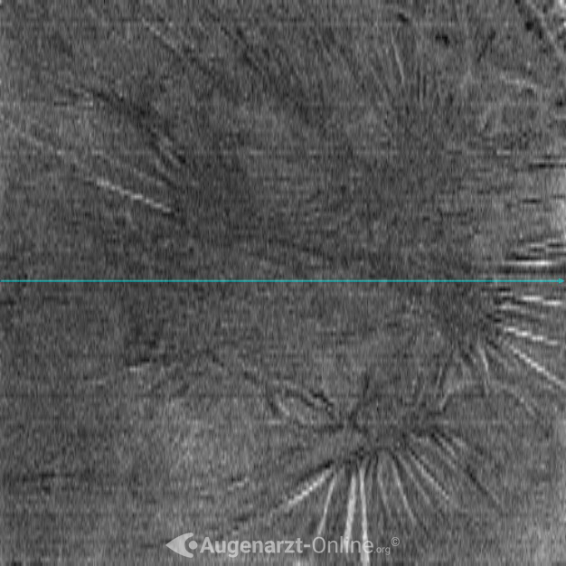 Epiretinale Gliose