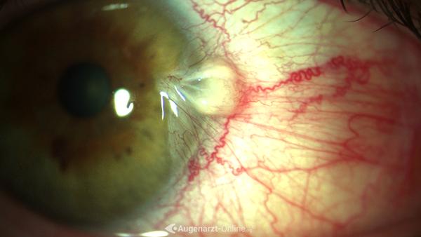 Pterygium