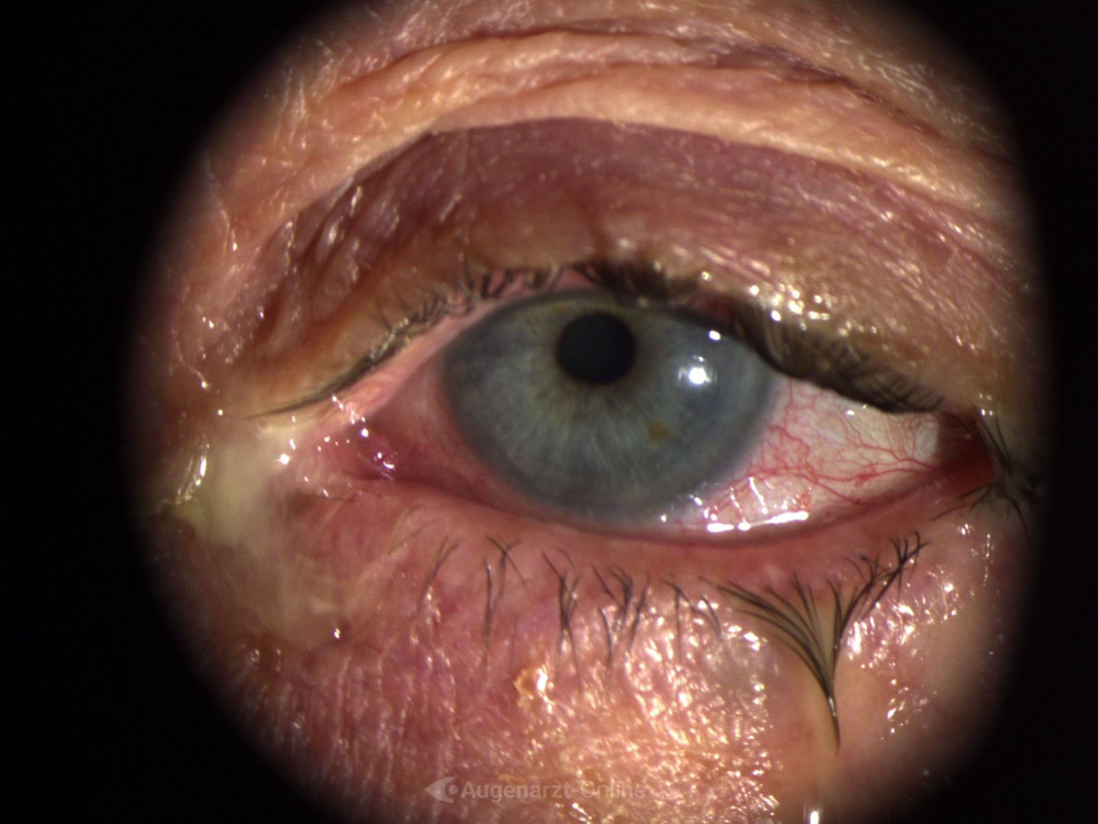 Spaltlampenfoto zu Bakterielle Konjunktivitis (Bindehaut).