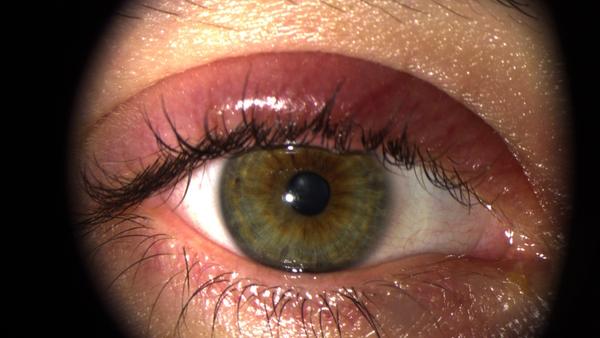 Spaltlampenfoto rechts zu Blepharitis.
