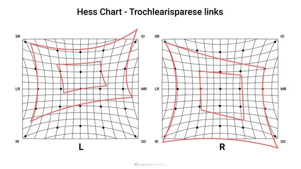 Hess Diagramm - Trochlearisparese