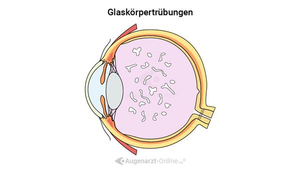 Glaskörpertrübung