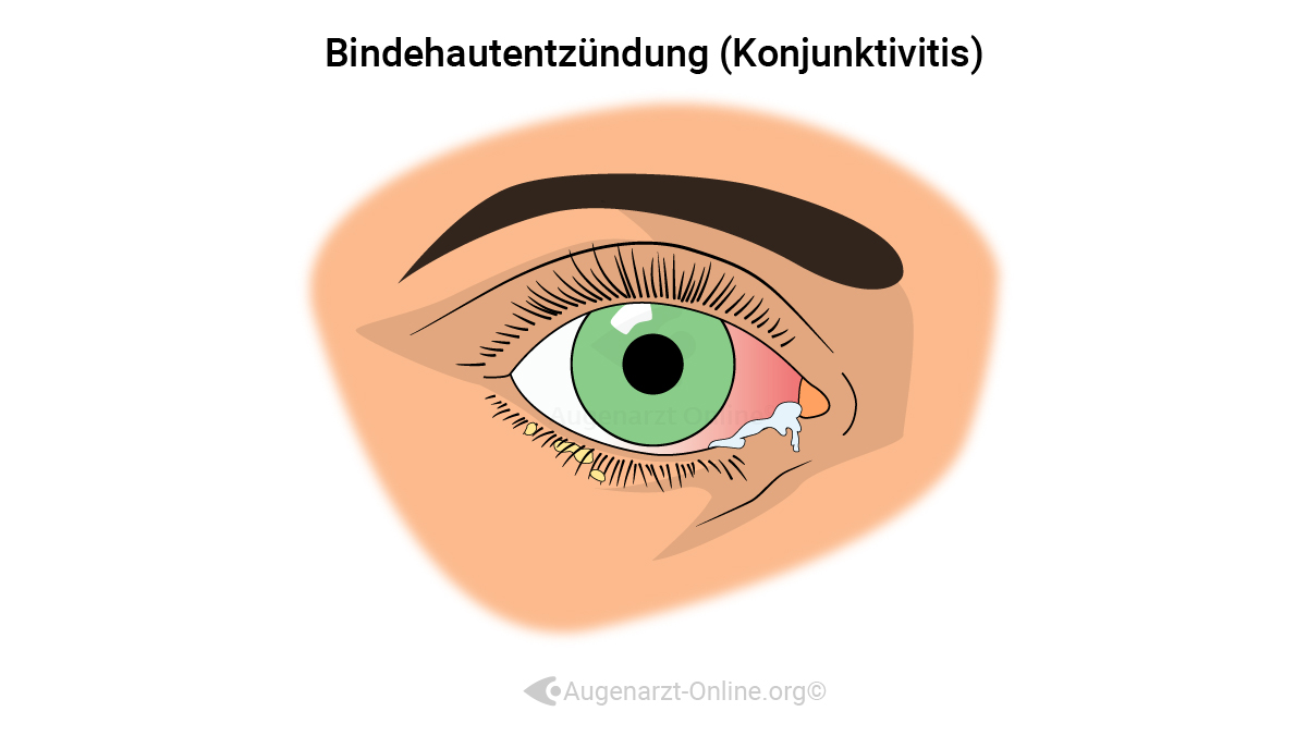 Bindehautentzündung
