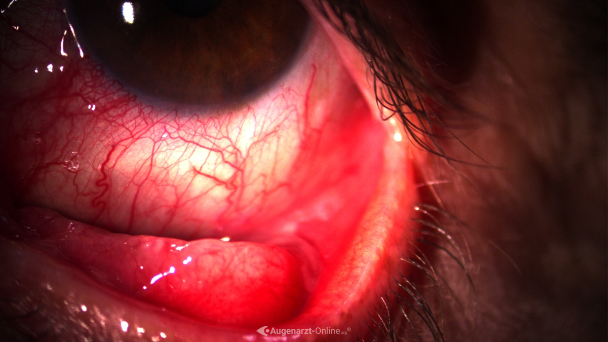 Konjunktivales Chalazion