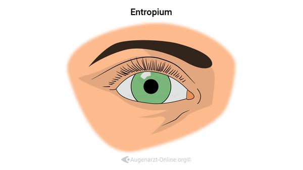 Entropium