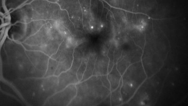 Diabetische Retinopathie (DRP)