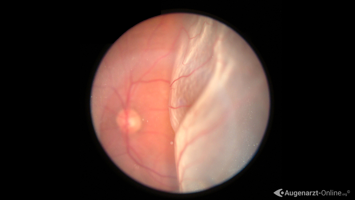Ablatio retinae