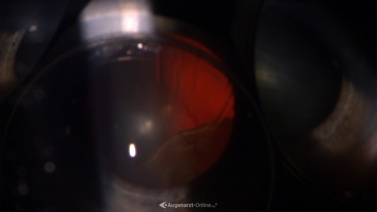 Ablatio Retinae