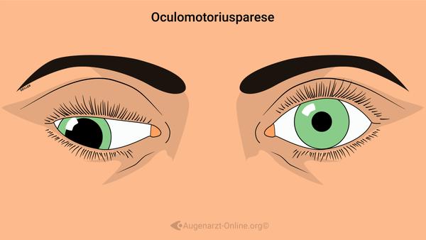 Oculomotoriusparese