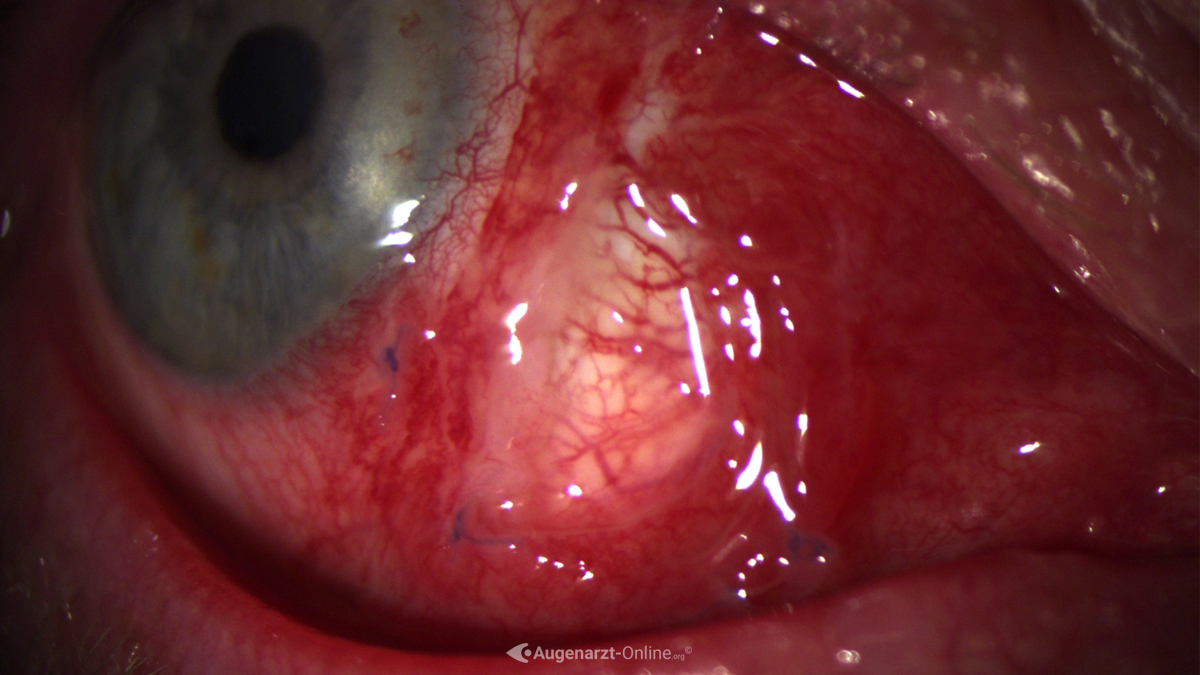 Bindehautlazeration nach Pterygium