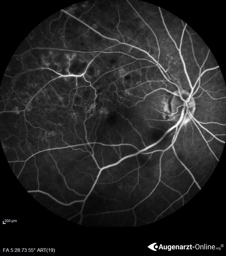 Venenastthrombose