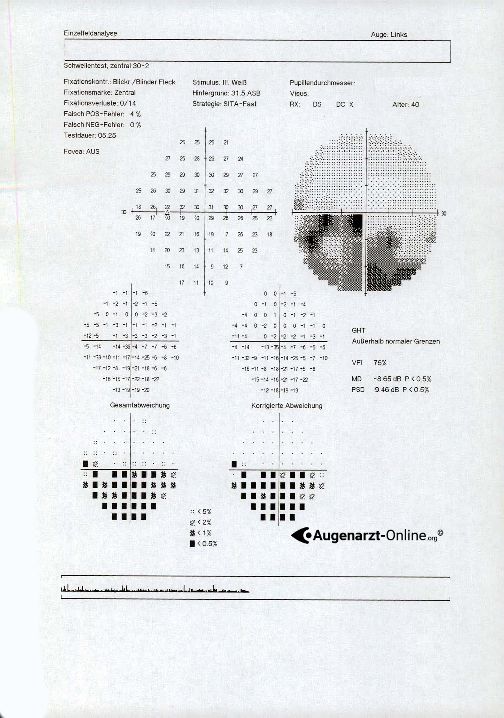 Gesichtsfeld bei Retrobulbärneuritis