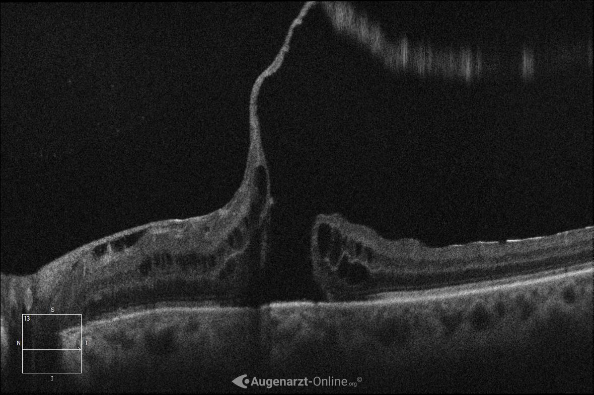 Makulaforamen bei vitreomakulärer Traktion