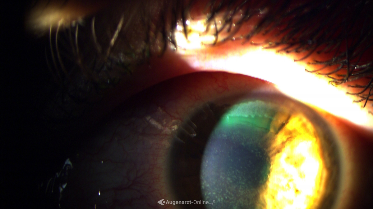 Erosio cornea