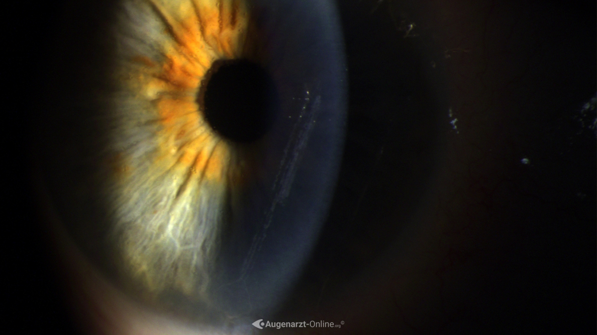 Erosio cornea