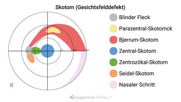 Gesichtsfeldausfall (Skotom)