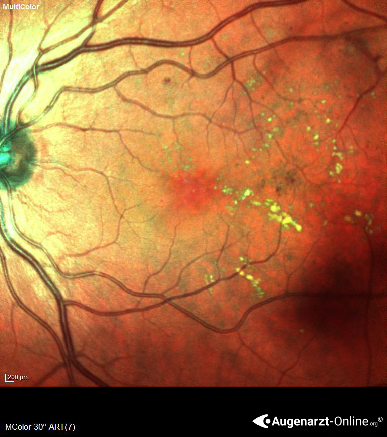 Proliferative Diabetische Retinopathie