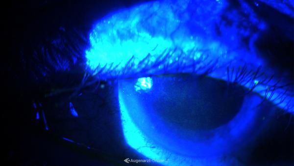 Stippung der Hornhaut (Fluorescein)