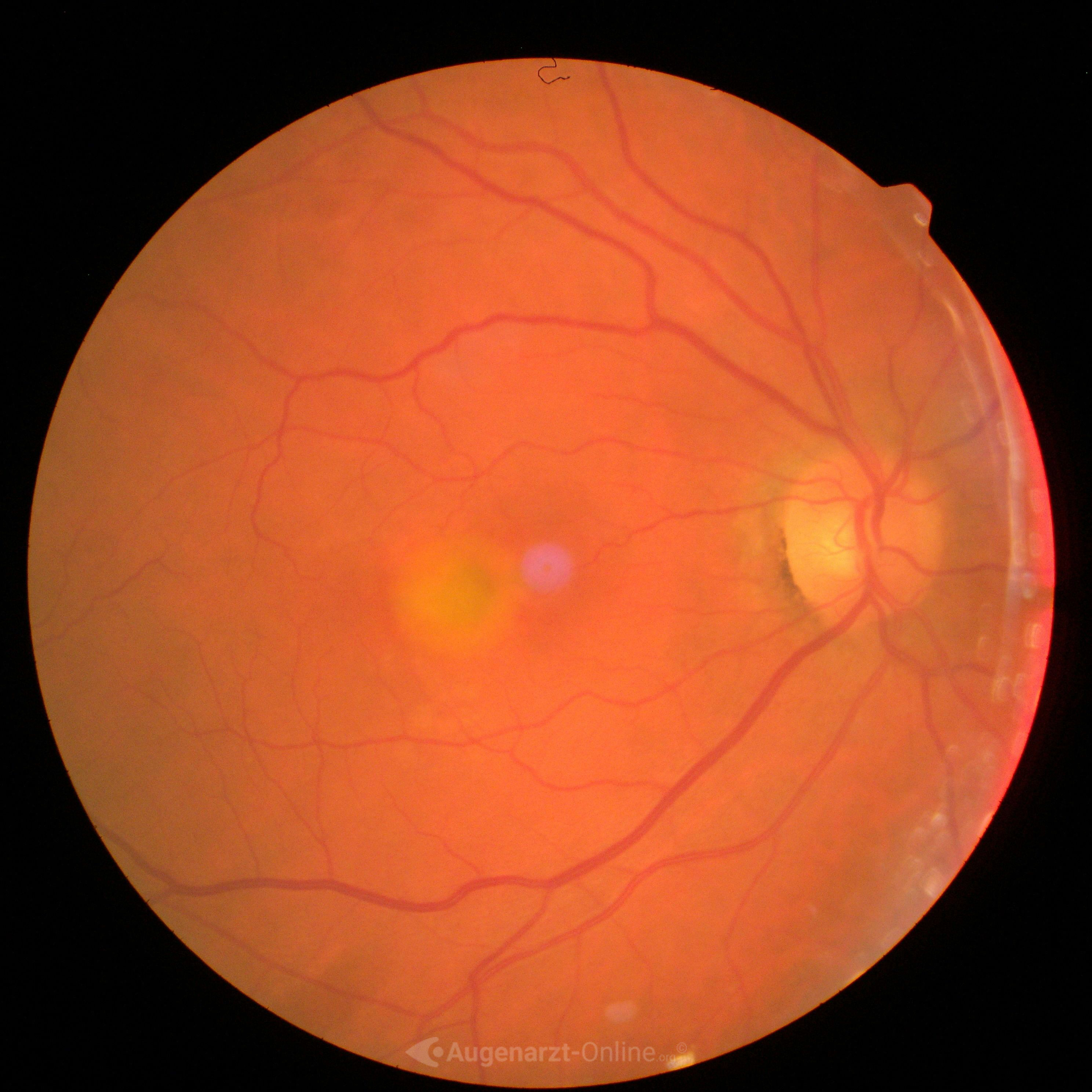 Ophthalmologisches fundusfoto beidseits mit Bezug zu Adulte vitelliforme Makuladystrophie.
