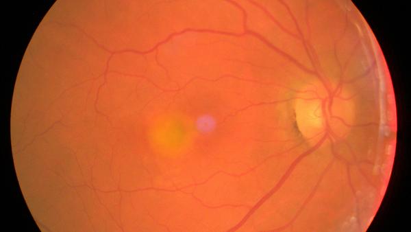 Ophthalmologisches fundusfoto beidseits mit Bezug zu Adulte vitelliforme Makuladystrophie.