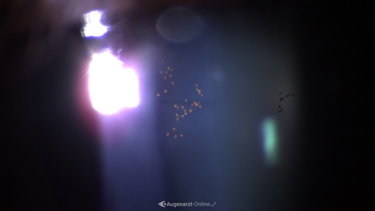 Epicapsular Stars