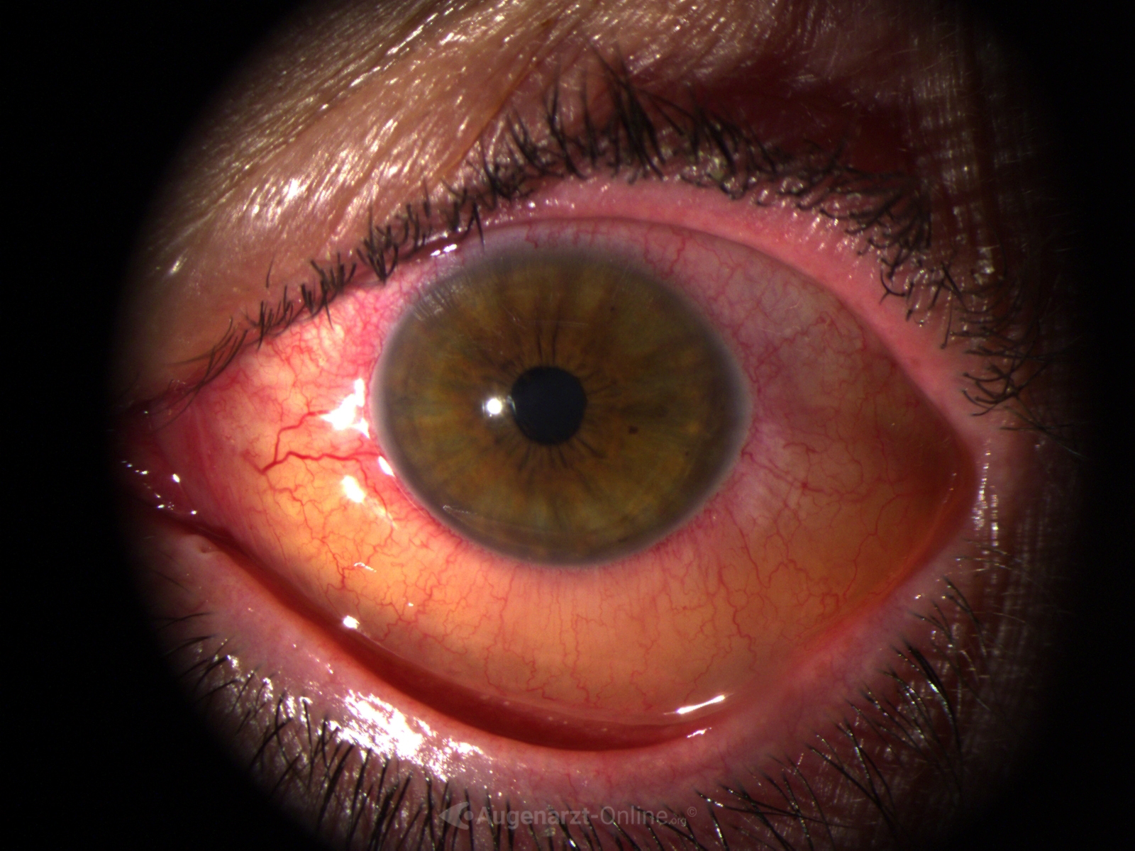 Bindehautchemose bei Uveitis (M Behcet) in Spaltlampenfoto.