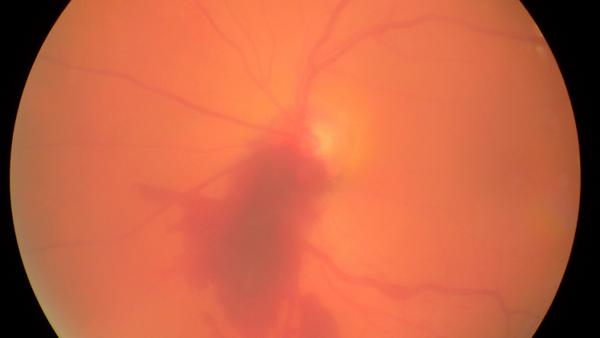 Spaltlampenfoto zu Frische Glaskörperblutung mit Quelle bei Hypertonie (Glaskörper).