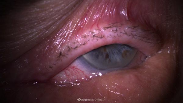 Entropium