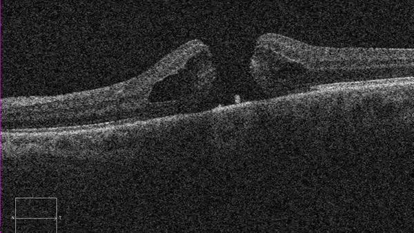 Makulaforamen