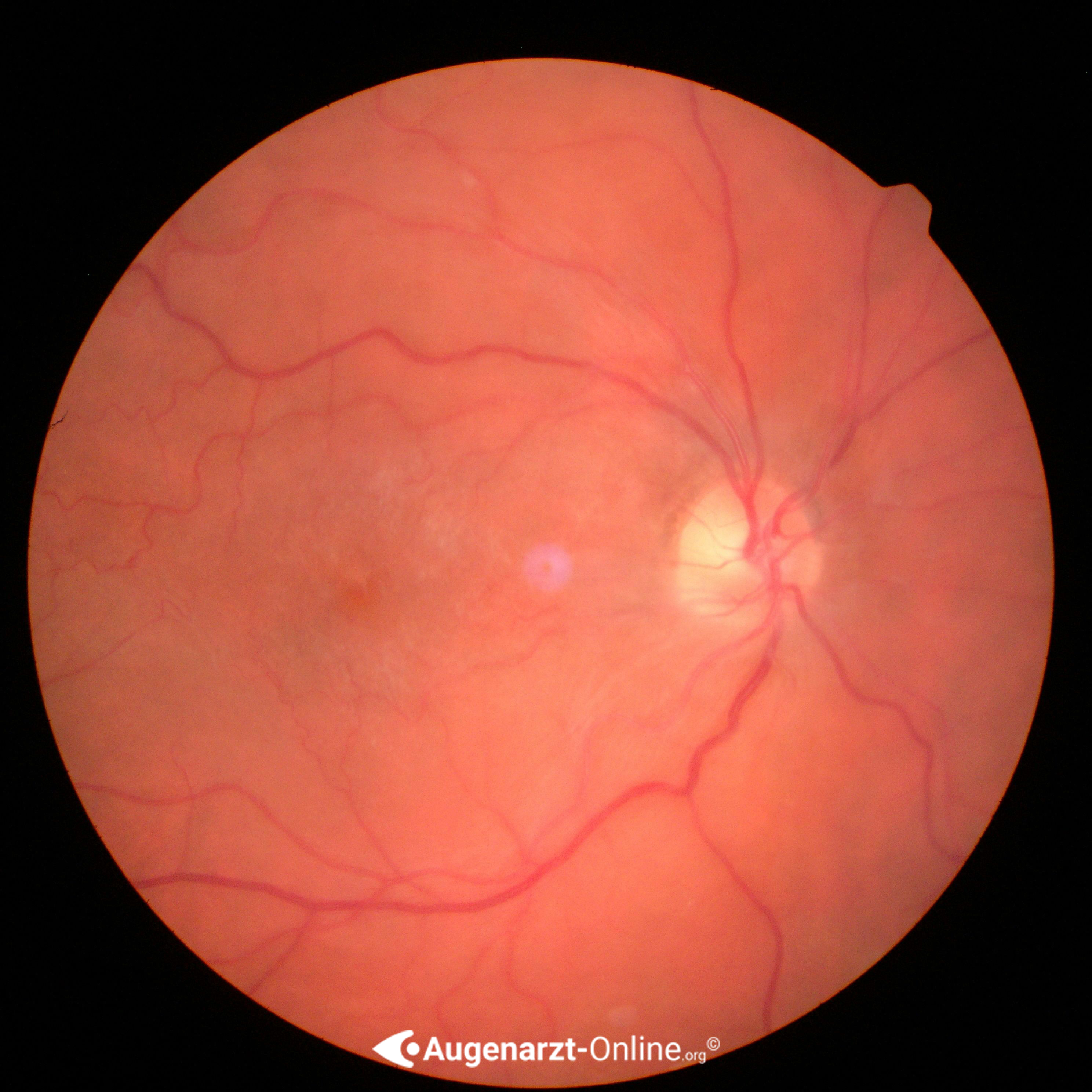 Epiretinale Gliose