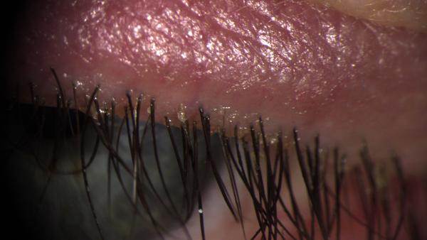 Spaltlampenfoto rechts zu Demodex Blepharitis.