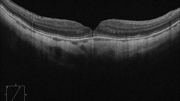 Fundus Myopicus