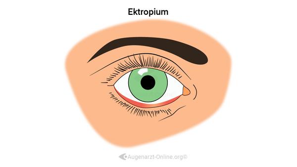 Ektropium