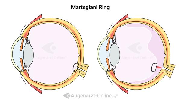 Martegiani Ring Glaskörpertrübung Mouches volantes