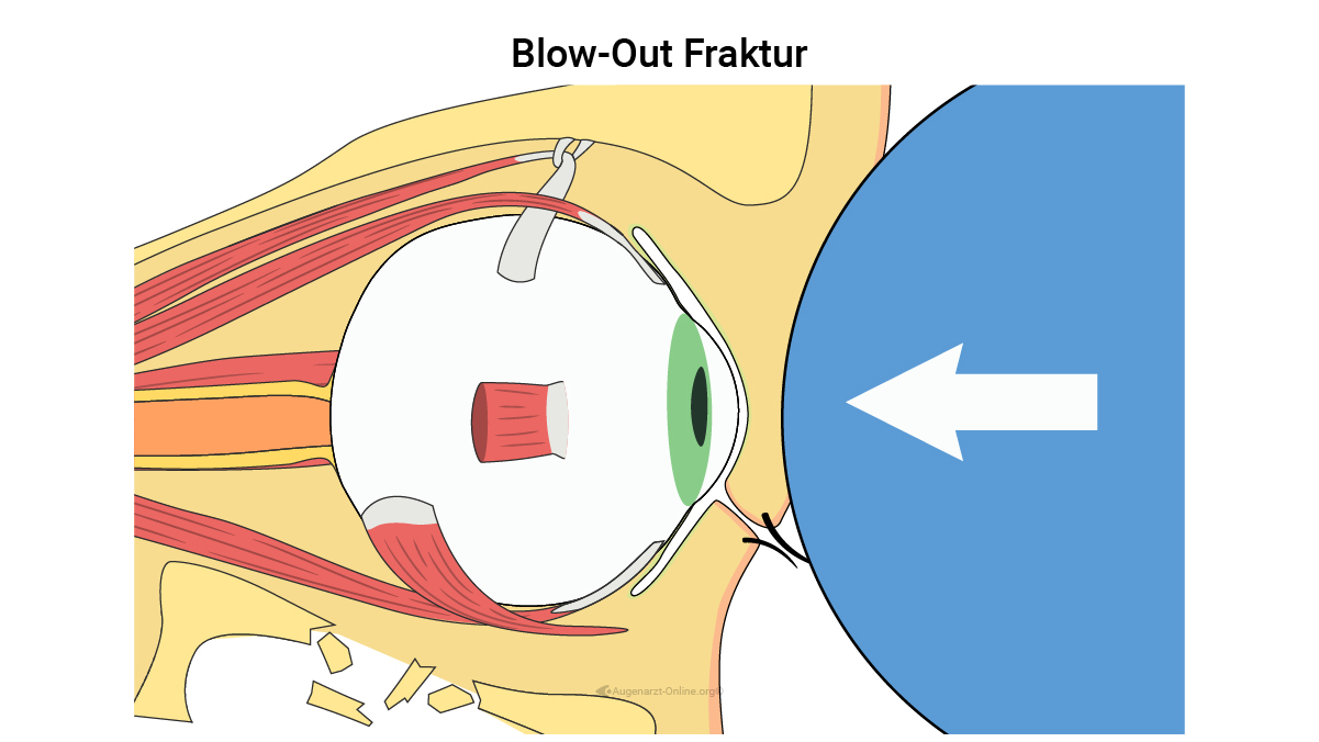 Blow-Out Fraktur
