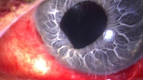 Spaltlampenfoto: Optic Capture und Hyposphagma.