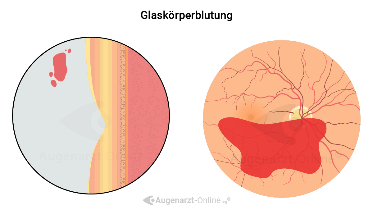 Glaskörperblutung